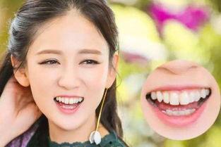 明星网红修复牙齿,揭秘明星美齿秘籍